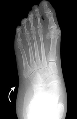 What kind of surgery is available for flat feet?